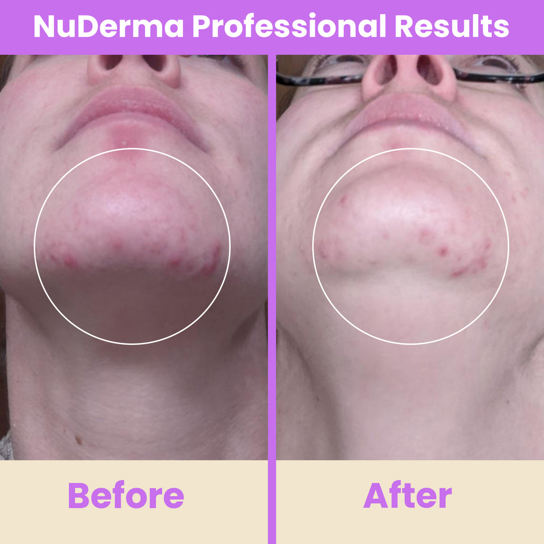 NuDerma Professional High Frequency Wand