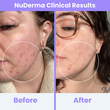 NuDerma Clinical High Frequency Wand – Pure Daily Care