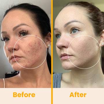 NuDerma Standard High Frequency Wand – Pure Daily Care