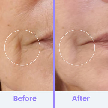 NuDerma Clinical High Frequency Wand – Pure Daily Care