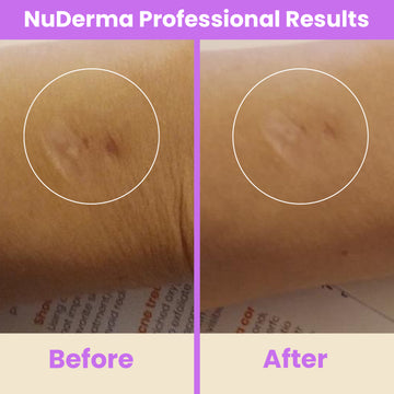 NuDerma Professional High Frequency Wand – Pure Daily Care