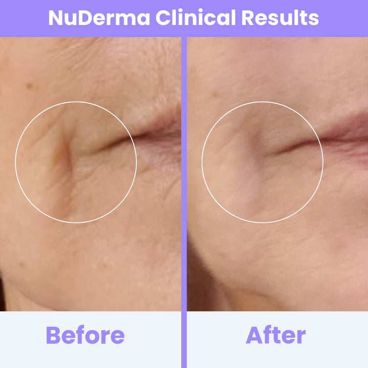 NuDerma Clinical High Frequency Wand