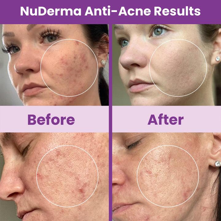 NuDerma Standard Complete High Frequency Bundle – Anti-Acne